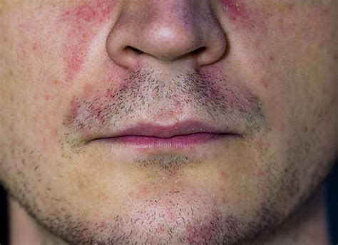 Eczema Nose
