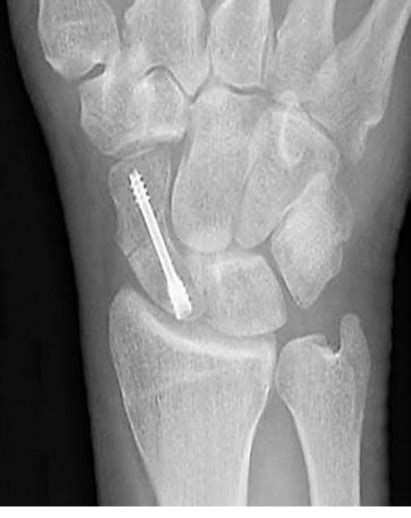 Scaphoid Fracture Fixed With A Herbert Screw 1 Preserved Intact