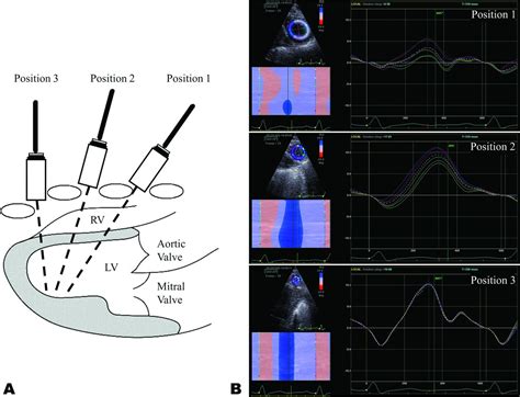 Left Ventricular Twist Dynamics Principles And Applications Heart