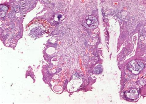 Pathology Outlines Rhinosporidiosis