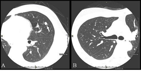 Metastatic lesions of hepatocellular carcinoma in the lungs of case 2... | Download Scientific ...