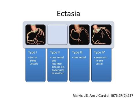 Coronary Artery Aneurysms and Ectasia