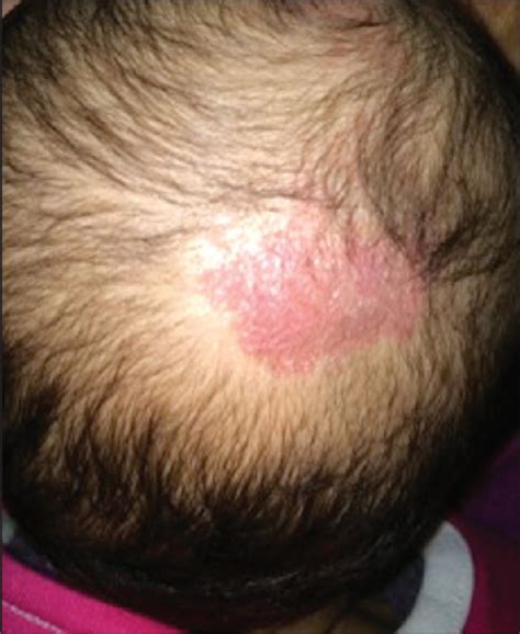 Cerebral Hemangioma Symptoms Causes Treatment