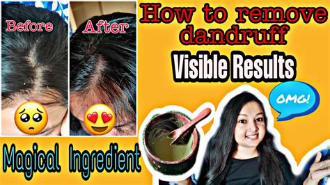 HOW TO REMOVE DANDRUFF NEEM POWDER FOR DANDRUFF NEEM HAIR PACK