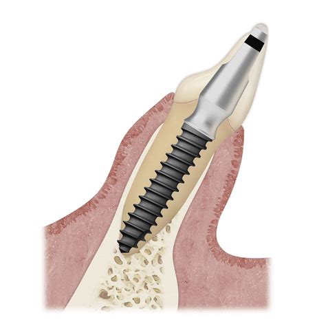 Cylindrical Dental Implant Ms Implant Surface Sa Osstem Implant