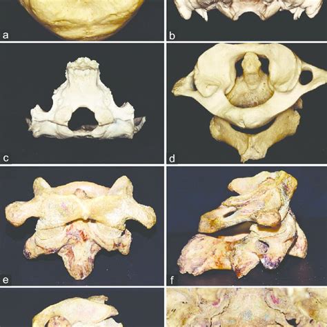 Stepwise Dissection Of Posterior Approach To Craniovertebral Junction Download Scientific