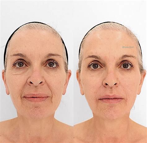 Non Surgical Facelift Procedures Vancouver One Clinic Md