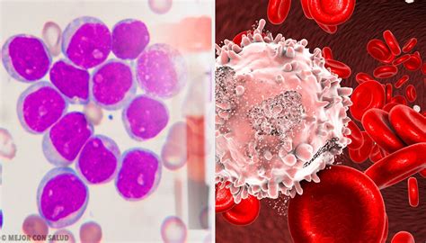 Leucemia mieloide crónica Mejor con Salud