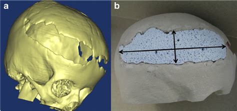 Case 3 3D CT Scan Showing A Post Traumatic Right Fronto Parietal Bone