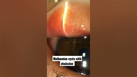 Meibomian Cysts With Chalazion Youtube