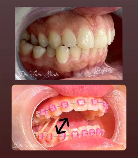 Dr Zara Shah On Linkedin Crossbite Elastics These Elastics Usually