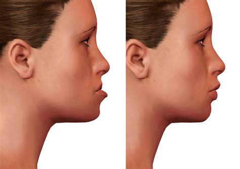 Better Balance With Jaw Surgery Shirley Ny