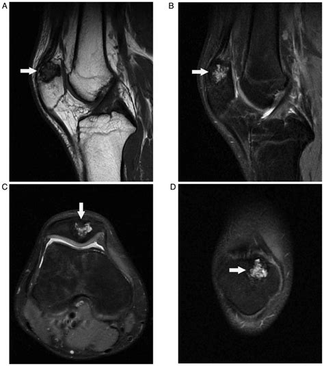 Osteoblastoma Of The Patella A Rare Benign Bone Tumor With An Uncommon