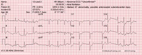 Inferior St Depression Ekg