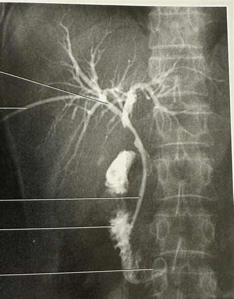 Percutaneous Transhepatic Cholangiography Ptc Diagram Quizlet