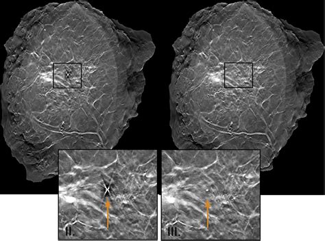 High Attenuation Artifact Reduction In Breast Tomosynthesis Using A