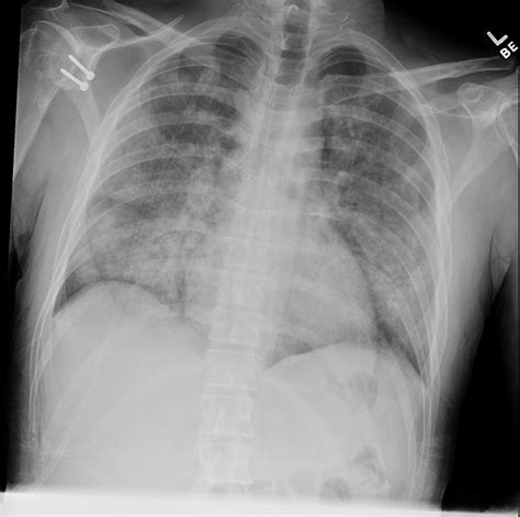 Electronic-Cigarette or Vaping Associated Lung Injury (EVALI) | Applied ...
