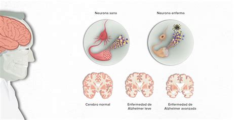 Qué es la enfermedad de Alzheimer PortalCLÍNIC