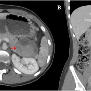 Abdominal CT Scan After 2 Months Of Follow Up A Axial View And B