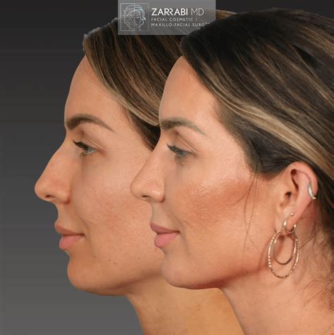 Piezo Ultrasonic Rhinoplasty Dr Shahrouz Zarrabi Md