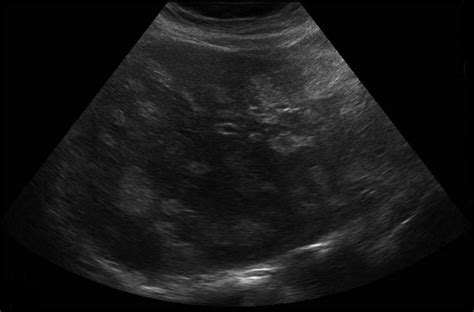 Abdominal Ultrasound Showing Multiple Hyperechoic Liver Lesions