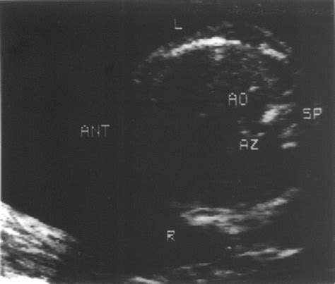 Cross Section Through The Fetal Thorax At The Level Of The Diaphragm Download Scientific