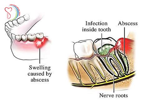 Jaw Infection Causes Symptoms Treatment 58 Off