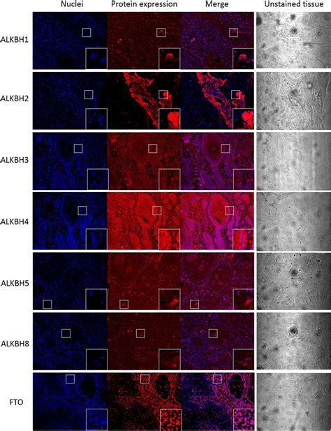 Alkbh Proteins Expression In The Hnscc Tissue In Ii Stage Accordingly