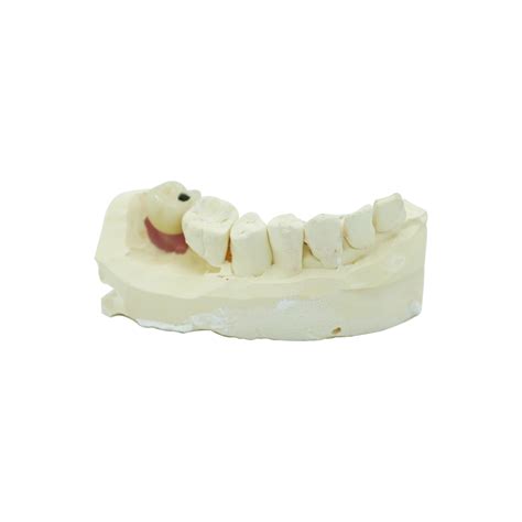 Istar Screw Retained Implant Crown Precision Restoration
