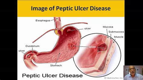 Peptic Ulcer Lecture Youtube