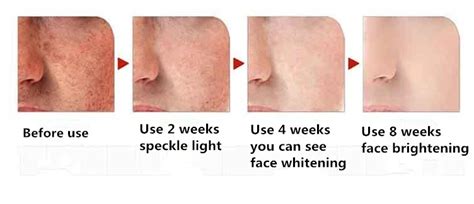 Dimollaure Bleaching Creme starke Wirkung 20g entfernt Sommersprossen ...