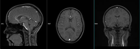 Temporomandibular Joints Tmjs Mri Planning And Protocols