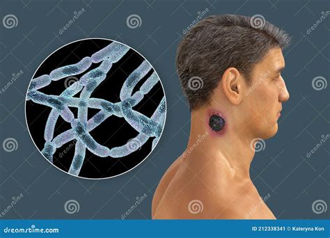 Cutaneous Anthrax, the Most Common Form of Anthrax Stock Illustration ...