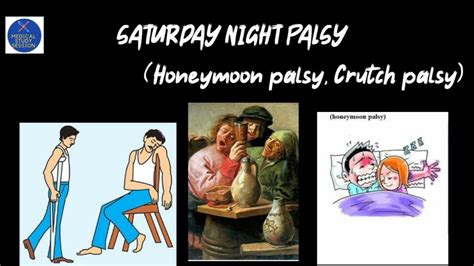 Saturday Night Palsy (Honeymoon palsy,Crutch palsy) in easy way - YouTube