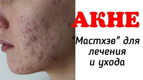 Лучшие средства и рецепты для лечения акне, постакне - YouTube