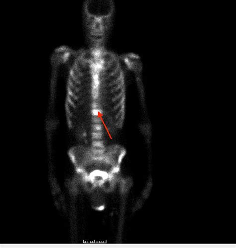 Bone Scan Showing Multiple Areas Of Increased Uptake The Arrow Points