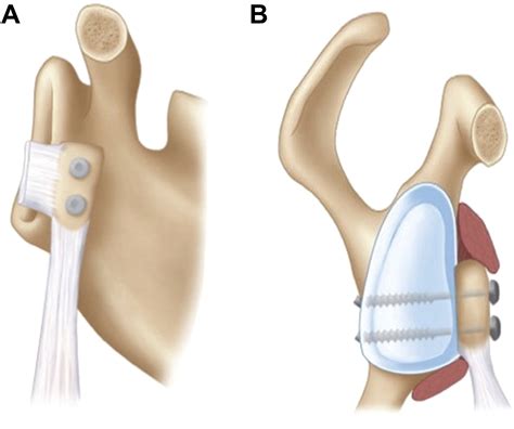 The Outcomes And Surgical Techniques Of The Latarjet Procedure