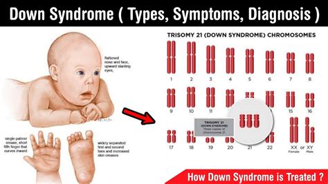 Down Syndrome Types Of Down Syndrome Symptoms Treatment Diagnosis