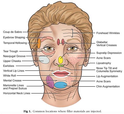 5 Top Aesthetic Filler Injections Techniques In 2022 Injectables