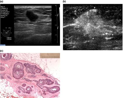 Comparison Of Conventional Ultrasound And Contrast Enhanced Ultrasound