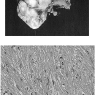 Images Of The Resected Esophageal Submucosal Tumor Smt A Gross