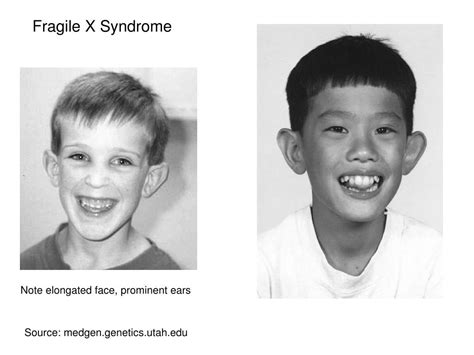 Ppt Fragile X Syndrome Powerpoint Presentation Id340016