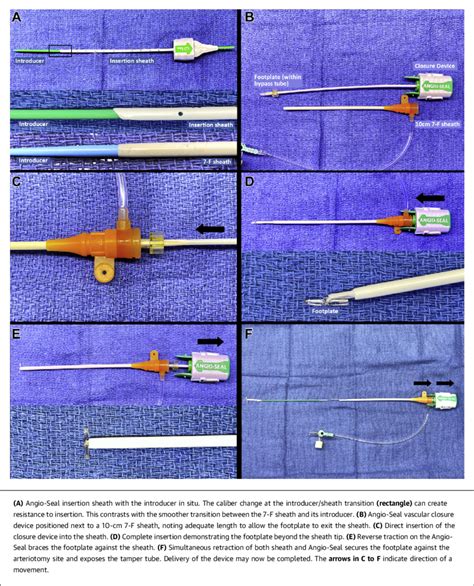 Angio-Seal Deployment | Download Scientific Diagram