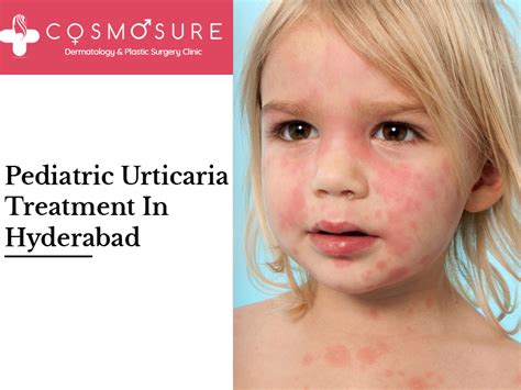 Pediatric Urticaria Treatment In Hyderabad Cosmosure Clinic