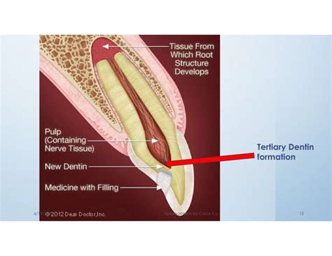 Management Of Incomplete Root Apex For Vital Tooth Ppt