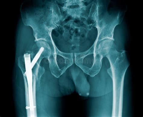 Hip Fracture