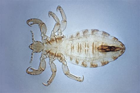 Pediculosis Corpus