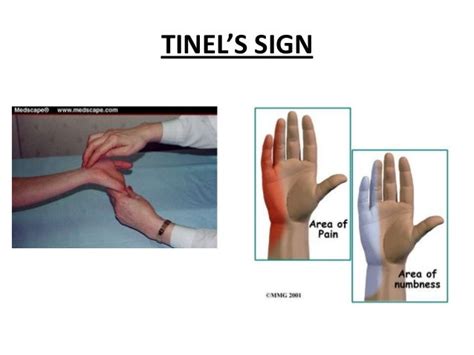 Peripheral Nerve Disorders