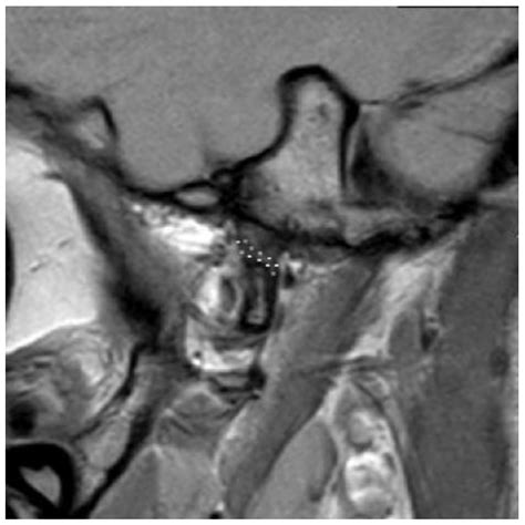 Bioengineering Free Full Text A Proposal For The Classification Of Temporomandibular Joint