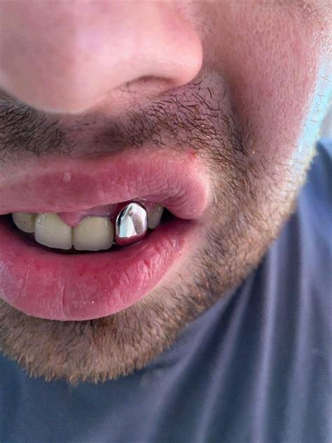 silver teeth